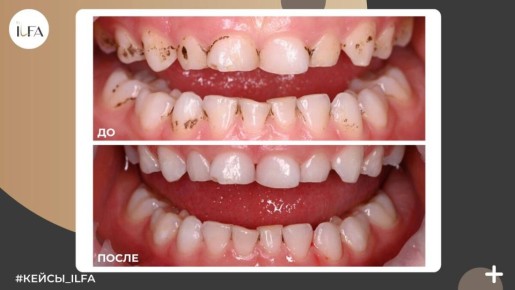 Налёт Пристли: Как С ним Борются Стоматологи?